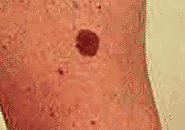 Mole Removal At Tandon Clinic Delhi