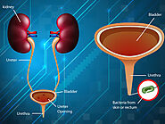 Tips to Find Relief in Urinary Tract Infections - Urologist