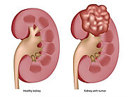 What is Kidney Cancer? - Urologist