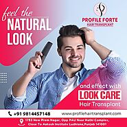 Hair Transplant in Ludhiana