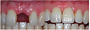 Dental Implant in Noida - Dr. Rajesh Agarwal