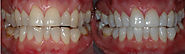 Teeth Whitening, Root Canal Treatment in Noida
