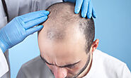 Hair Transplant in Ludhiana - Give a brief description of the grey hair transplant surgery?