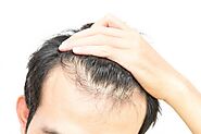 Hair Transplant in Ludhiana - What advantages does a patient attain after having the hair transplant procedure? – Art...