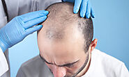 Hair Transplant in Ludhiana - How Can You Defeat The Problem Of Stress And Parallel Your Hair Growth? -