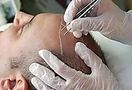 What is the success rate of hair transplantation procedures? – Articla Di Hatti – Bloggers Unite India