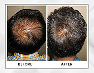 Get Hair Loss Treatment In Kolkata - Dr Paul's