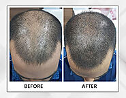 Consult Hair Loss Treatment in Kolkata: Dr Pauls
