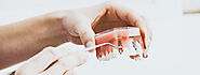 Implant Supported Dentures in Aiken, SC - Dr. Trey Vereen, DMD