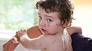What is chickenpox? Symptoms and treatment | Bloggalot.com