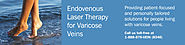 What Treatment Options Do You Have For Those Varicose Veins?