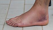 Understanding Sprained Ankles: How Long Does Swelling Last?