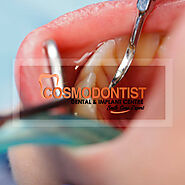 Why Dental Scaling Or Teeth Cleaning Is Necessary - Cosmodontist Dental Clinic in Gurgaon