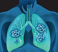 Is Treatment for Lung Cancer in India Possible?