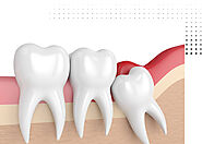 Painless Wisdom Tooth Removal in Pune | Vanilla Smiles
