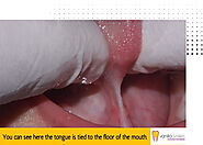 Tongue Tie Treatment in Shivaji Nagar, Pune | Vanilla Smile