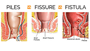 Difference between Piles, Fissures and Fistula - Medfin