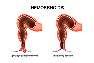 Piles or Hemorrhoids - Causes, Symptoms, Diagnosis and Treatment