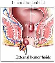 बवासीर का होम्योपैथिक इलाज बवासीर के लिए होम्योपैथिक इलाज - Homeopathic Specialist‎ Dr Harsh Sharma