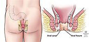 Anal Fissures: Causes, Symptoms, Treatment & Prevention