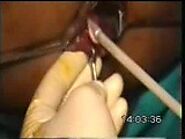 Cryosurgery Of Piles • Video • MEDtube.net