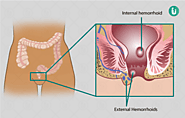 Piles surgery: Cost, Pain, Recovery time, Procedure, Purpose, Results, Price