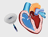 Atrial Septal Defects - Symptoms, Diagnosis, Treatment & Prevention in Hyderabad