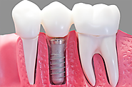 Are you in need of denture repairs services in Christchurch?