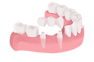 Denture a Long Lasting Replacement of Missing Teeth