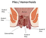 Homeopathy Treatment of Piles, Best Doctor For Piles in Mumbai