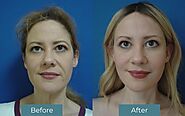 Plastic Surgery in Istanbul