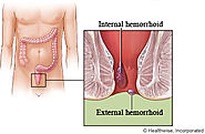 Hemorrhoidectomy: What to Expect at Home