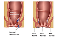 Know difference between piles, fissure, and fistula - FactDr