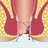 बवासीर के मरीजों के लिए डाइट प्लान : Diet Plan for Piles (Hemorrhoids) Patient