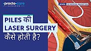 Piles Laser Surgery | Procedure Animation | Best Treatment for Piles | Practo Care Surgeries