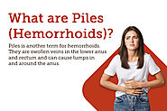 Piles: Symptoms, Causes, Treatment and Cost