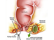 Kshar Sutra Treatment for Piles Fissure, Fistula in Delhi/NCR