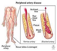8139105 symptoms of blocked arteries 185px