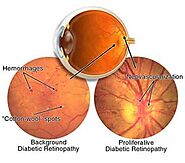 Diabetic Retinopathy Treatment in Mumbai | Eye Specialist- Doctor Eye Institute