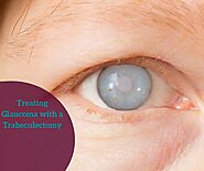 Treating Glaucoma with a Trabeculectomy | Doctor Eye Institute, Mumbai
