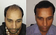 Dr Dutt Hair Transplant Centre For Best Hair Transplant in Delhi