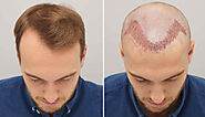 FUE vs. FUT Hair Transplant - What Are the Differences? - JustPaste.it