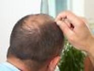FUE vs. FUT Hair Transplant - What Are the Differences?
