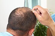 FUE vs. FUT Hair Transplant - What Are the Differences?