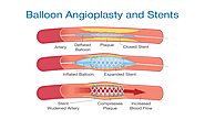 Coronary Angioplasty Stent Procedure, Angioplasty in Heart | Dr.Craghu