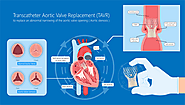 Aortic Valve Replacement: Expert Cardiologists in Hyderabad