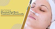 How To Cure A Chemical Peel Burn Treatment Professionally