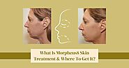 What Is Morpheus8 Skin Treatment & Where To Get It?