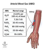 Arterial Blood Gas (ABG): What It Is, Purpose, Procedure & Levels