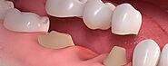 Dental Crowns | Dental Bridges for Teeth, Trichy Road, Coimbatore